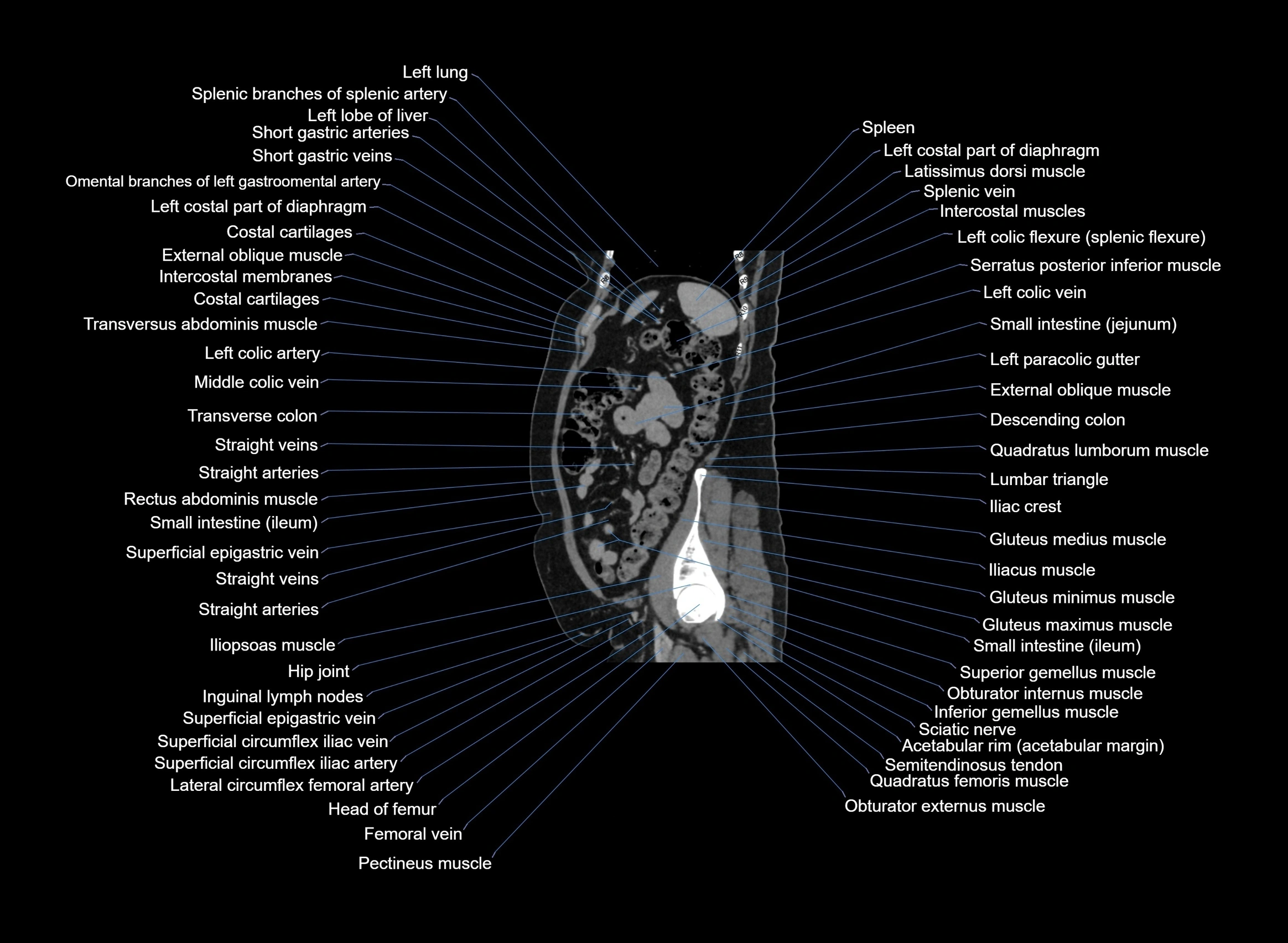 CT Abdomen sagittal cross sectional anatomy labelled radiology image -00029.webp